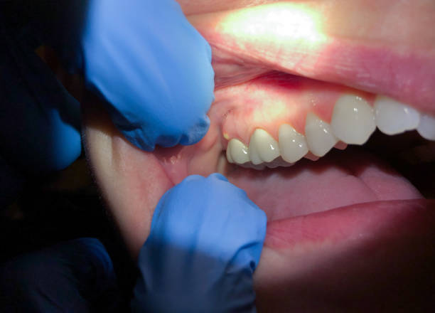 Best Emergency Dental Care for Abscessed Tooth in Goleta, CA